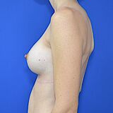 Brustvergrößerung, 32