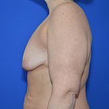 Bruststraffung mit Implantat, 45