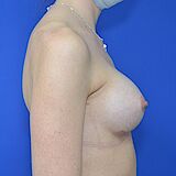 Brustvergrößerung, 24