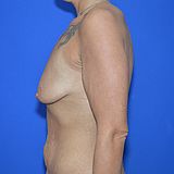 Bruststraffung mit Implantat, 33