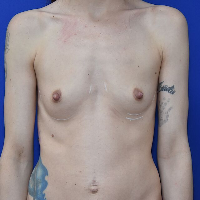 Brustvergrößerung, 33