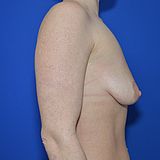 Bruststraffung mit Implantat, 37