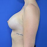 Brustvergrößerung, 29