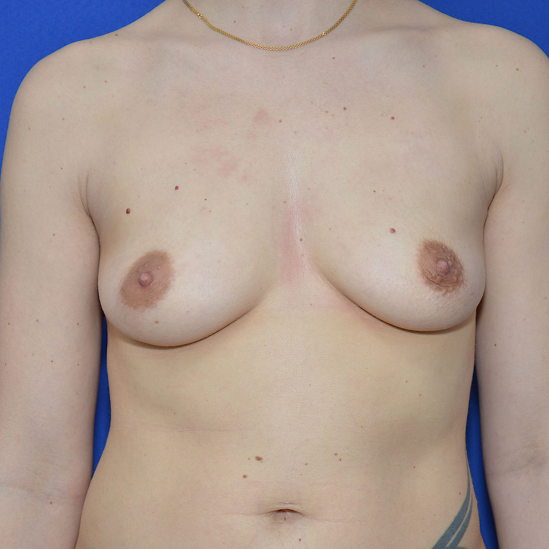 Bruststraffung mit Implantat, 32 Vorher Nachher