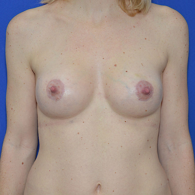 Bruststraffung mit Implantat, 39