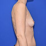 Brustvergrößerung, 43