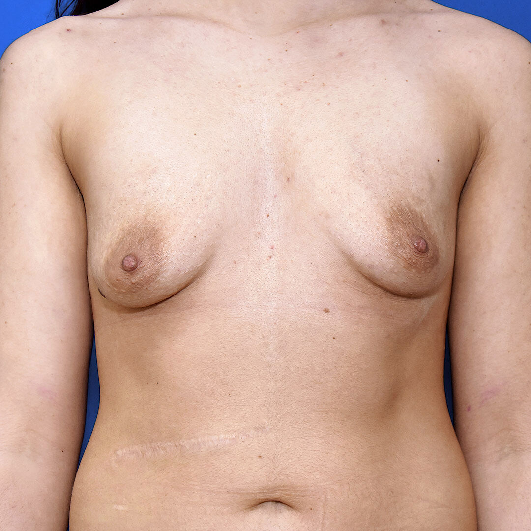 Bruststraffung mit Implantat, 26 Vorher Nachher