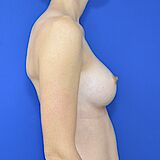 Brustvergrößerung, 32