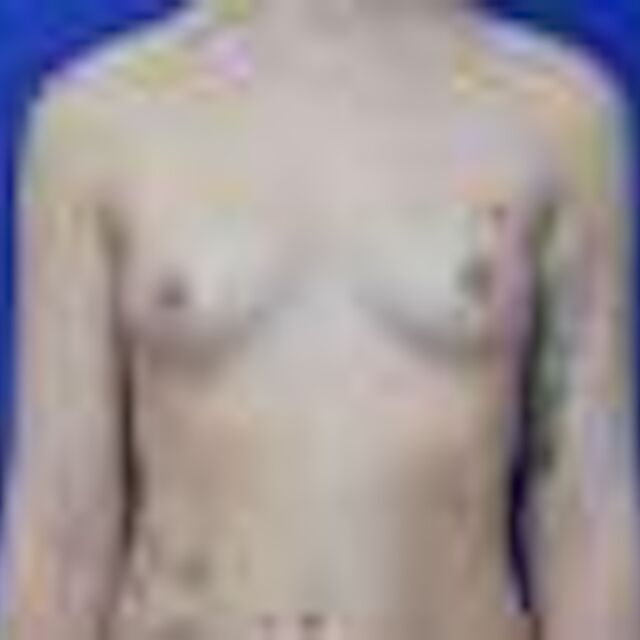 Brustvergrößerung, 31