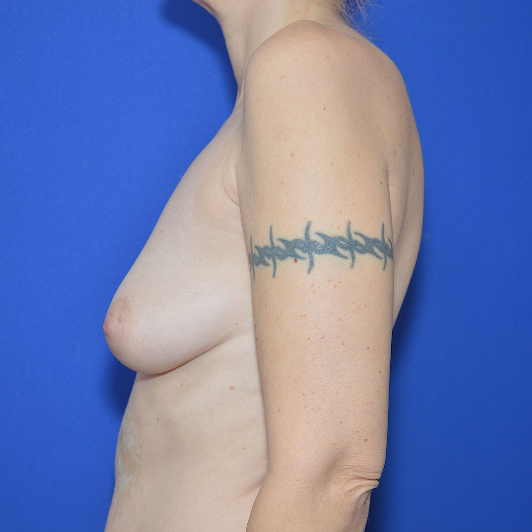 Bruststraffung mit Implantat, 48 Vorher Nachher