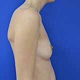 Brustvergrößerung, 32