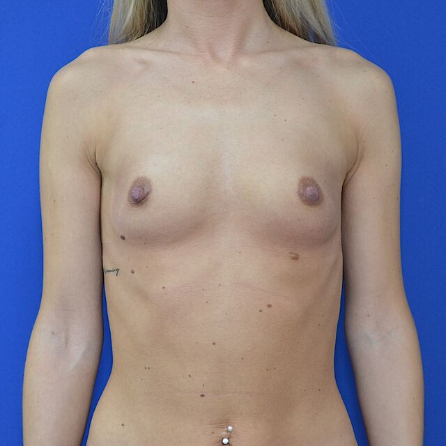 Brustvergrößerung, 26