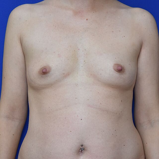 Brustvergrößerung, 32
