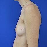 Brustvergrößerung, 32