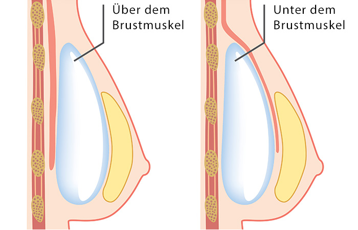 Die richtige Lage des Brustimplantats